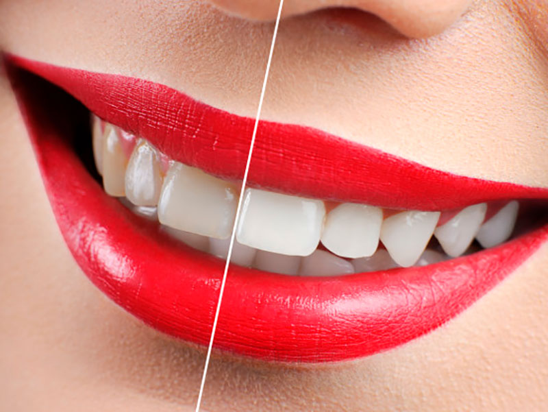 No centro da imagem está uma boca feminina com batom vermelho e um grande sorriso. Os dentes do lado esquerdo estão amarelados e opacos, e os do lado direitos estão brancos e brilhantes. Uma linga branca divide o sorriso, destacando a diferença.
