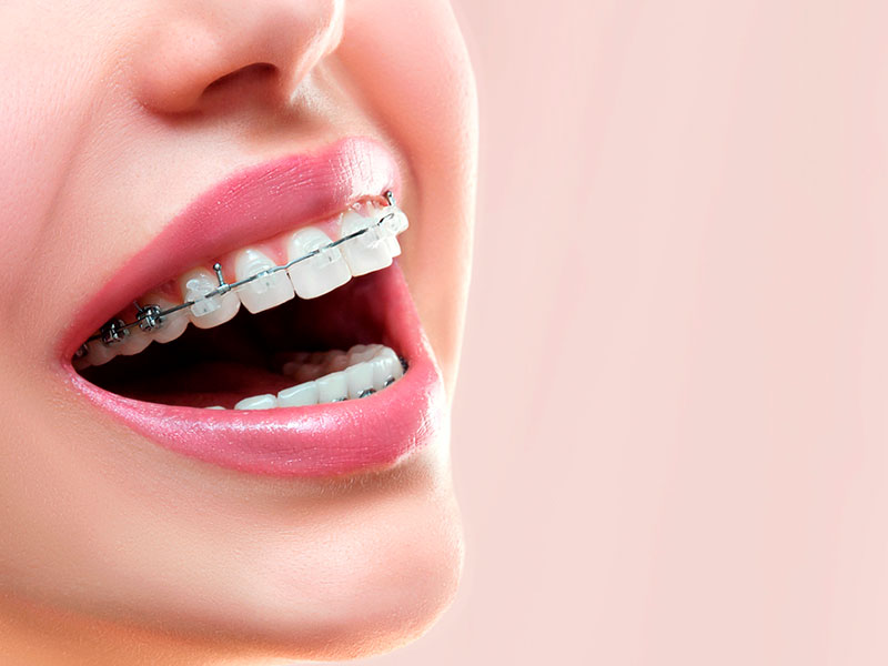 No canto esquerdo uma mulher está sorrindo, com a imagem em close na parte inferior do rosto. Sobre seus dentes está um aparelho dentário e os lábios usam um batom rosa.