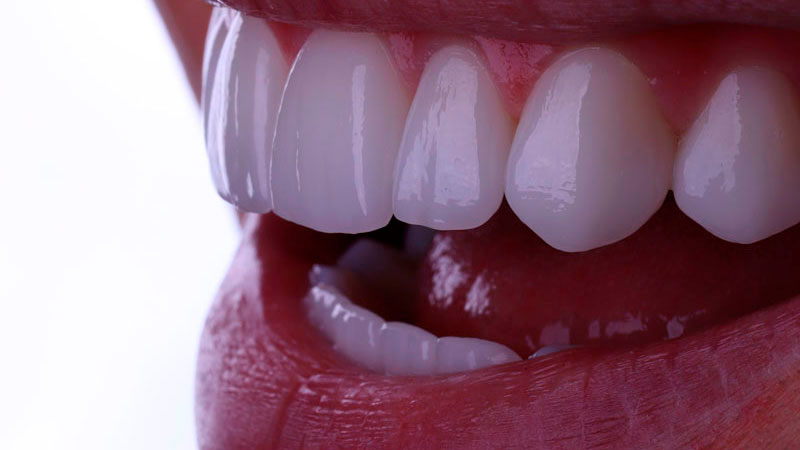 As Lentes de Contato Odontológicas são indicadas para harmonizar o sorriso.