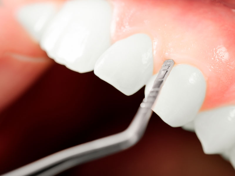 Na imagem em close, uma pinça odontológica toca a gengiva de um paciente acima do dente canino.