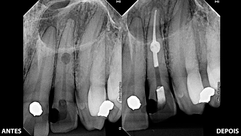 Imagem 1: Antes (cavidade aberta na parte interna do dente)Imagem 2: Depois (cavidade preenchida com gutta percha e cimento biocerâmico) 