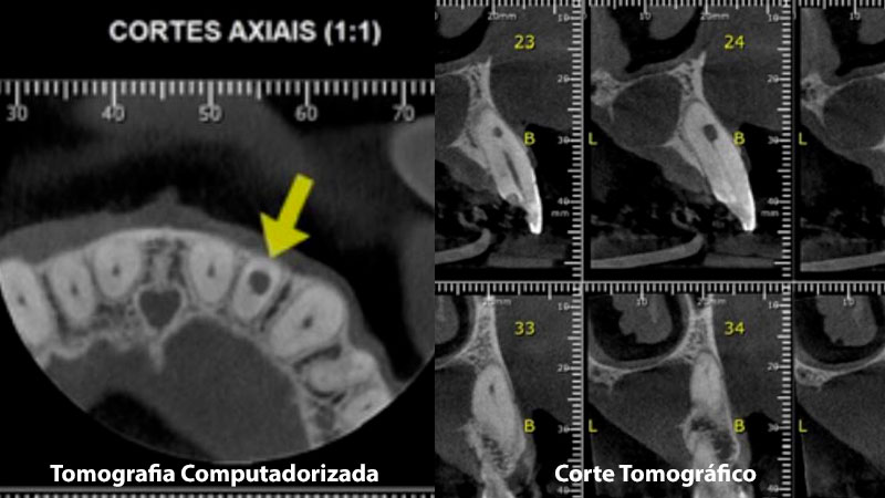 Imagem 3: uso de tomografia computadorizada em corte Axial para diagnóstico e auxilio no tratamento da RDI (neste caso não perfurante).Imagem 4: corte tomográfico sentido transversal, sendo possível visualizar a extensão e o formato da RDI