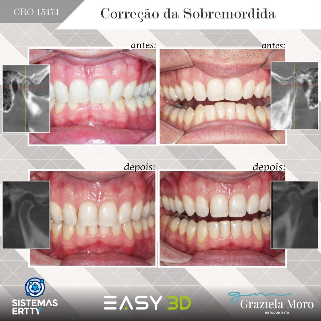Quais são os principais sintomas da ATM/DTM? - Ortodontia Curitiba