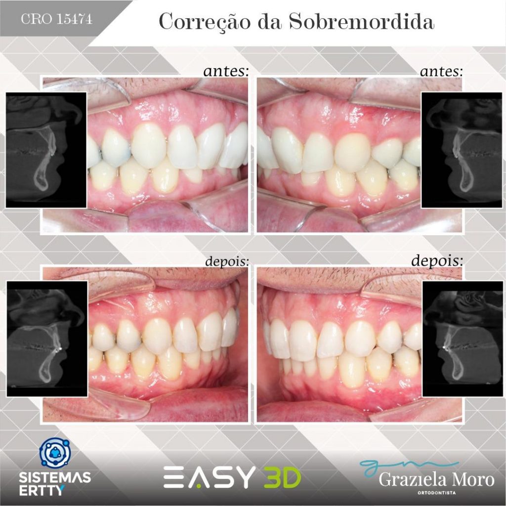 Distúrbios temporomandibulares - Distúrbios da boca e dos dentes