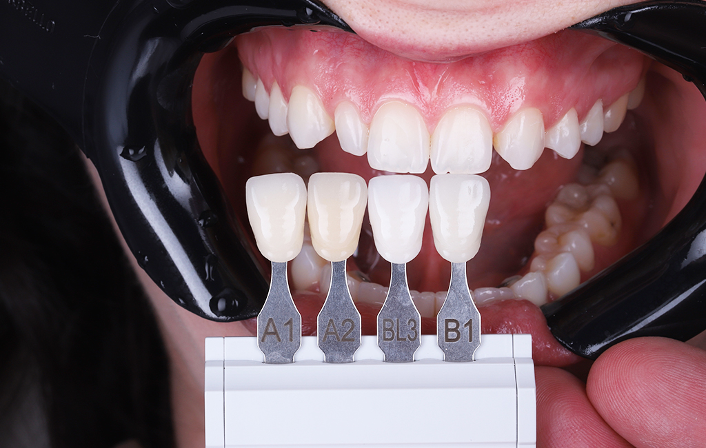 imagem fechada de uma boca, com os dentes brancos em destaque. Próximo a eles estão três lentes de contato dentais de cores diferentes.