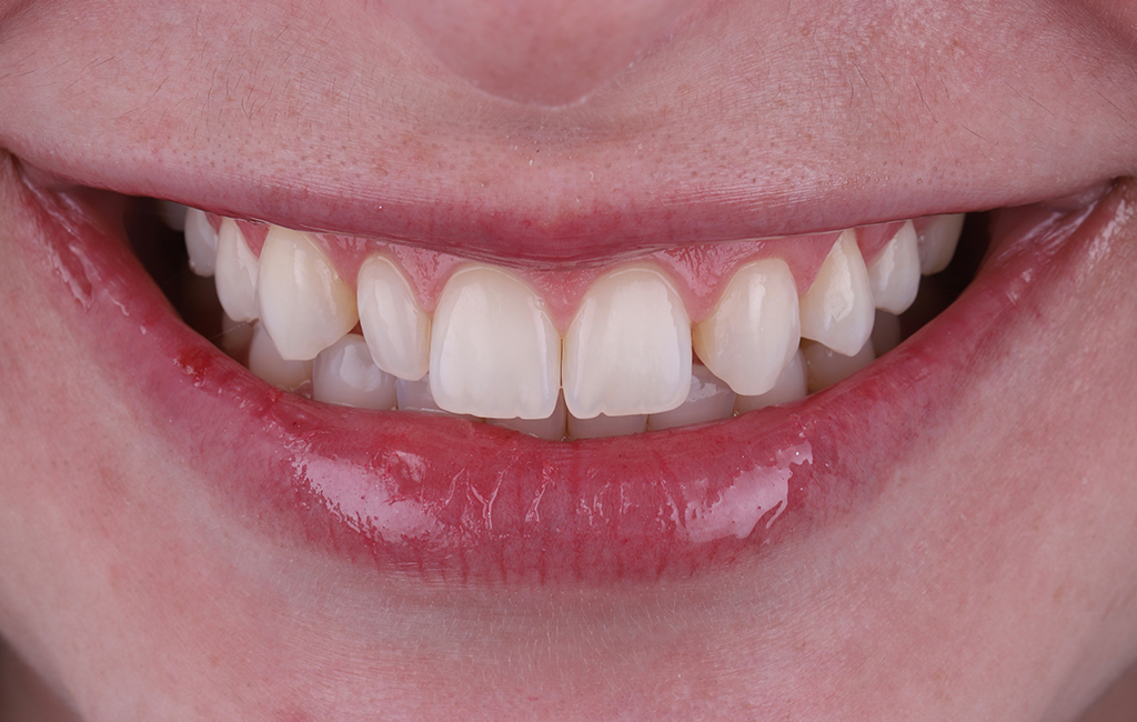 imagem em close de uma boca feminina sorrindo. Um dos dentes incisivos laterais é menor e o outro não existe.