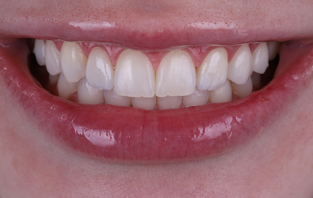 imagem fechada de uma boca feminina sorrindo. Os lábios estão levemente destacados com brilho labial.