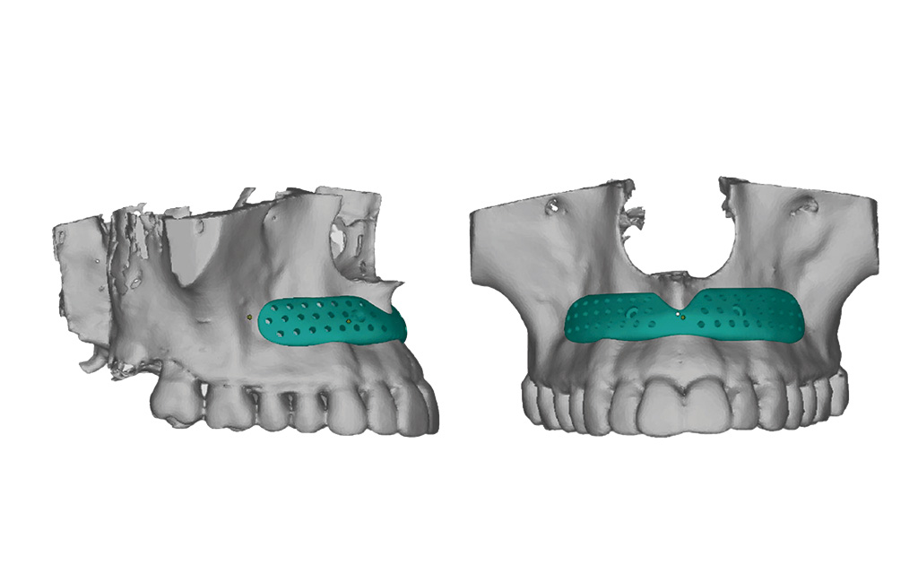 imagem em 3D com dois modelos de arcada dentária superior, o da esquerda está de lado e o da direita virado para frente. Ambos são brancos e no topo mostram um biovolume na cor verde.