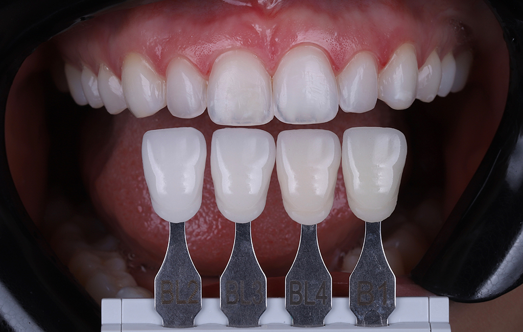 Imagem em close da arcada dentária superior da paciente. Embaixo estão quatro modelos de dente, com diferentes colorações.