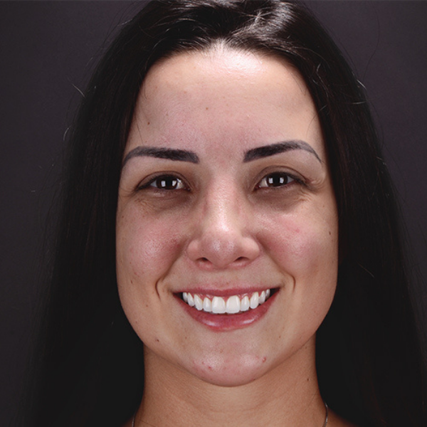 Imagem em close do sorriso de uma mulher branca. A boca está no centro da imagem. A mulher sorri, mostrando os dentes após a realização de um procedimento que reduziu a quantidade de tecido gengival que fica aparente no momento em que a mesma sorri.