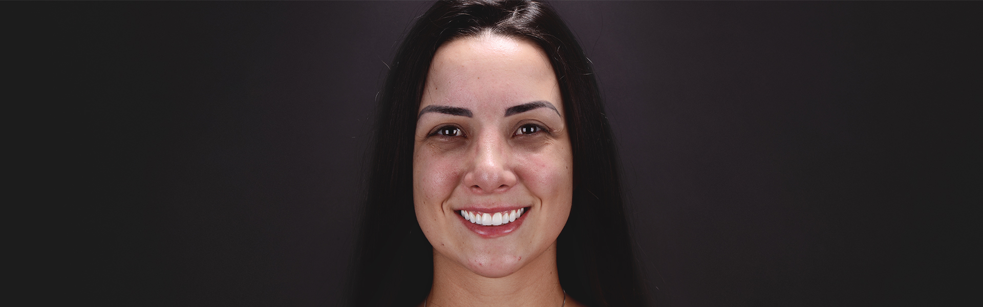 Imagem em close do sorriso de uma mulher branca. A boca está no centro da imagem. A mulher sorri, mostrando os dentes após a realização de um procedimento que reduziu a quantidade de tecido gengival que fica aparente no momento em que a mesma sorri.