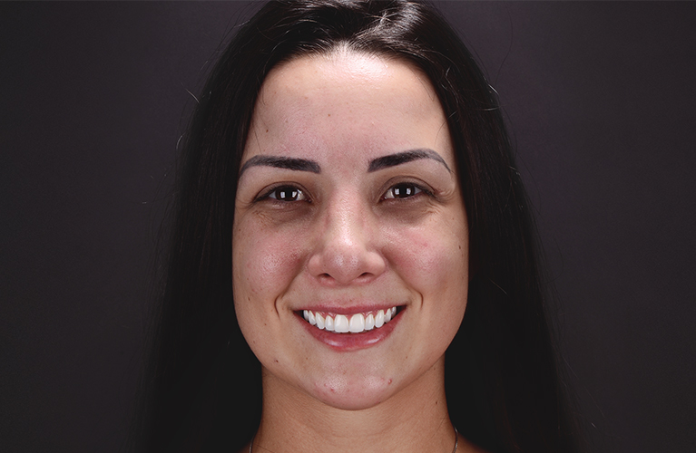 Imagem em close do sorriso de uma mulher branca. A boca está no centro da imagem. A mulher sorri, mostrando os dentes após a realização de um procedimento que reduziu a quantidade de tecido gengival que fica aparente no momento em que a mesma sorri.