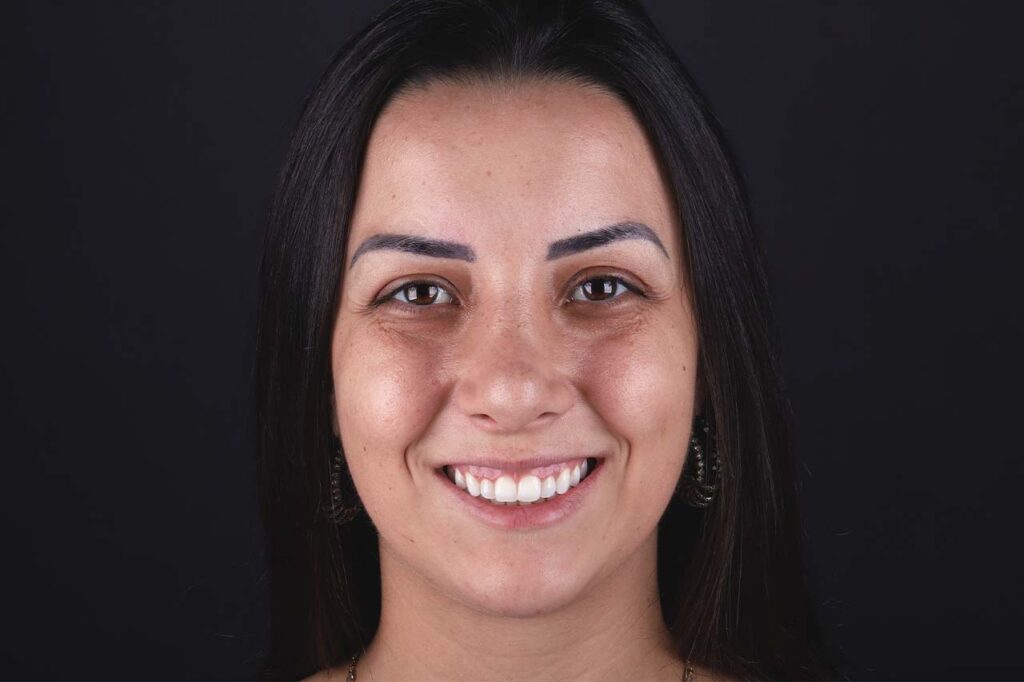 Imagem em close do sorriso de uma mulher branca. A boca está no centro da imagem. A mulher sorri, mostrando os dentes brancos, e um pouco da gengiva da parte superior da boca acima dos dentes