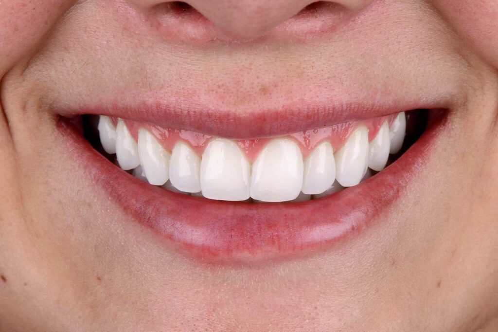 Imagem em close do sorriso de uma mulher branca. A boca está no centro da imagem. A mulher sorri, mostrando os dentes após a realização de um procedimento que reduziu a quantidade de tecido gengival que fica aparente no momento em que a mesma sorri.