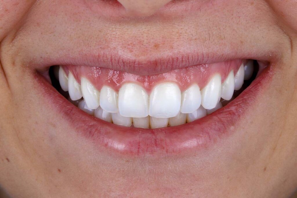 Imagem em close do sorriso de uma mulher branca. A boca está no centro da imagem. A mulher sorri, mostrando os dentes brancos, e um pouco da gengiva da parte superior da boca acima dos dentes.