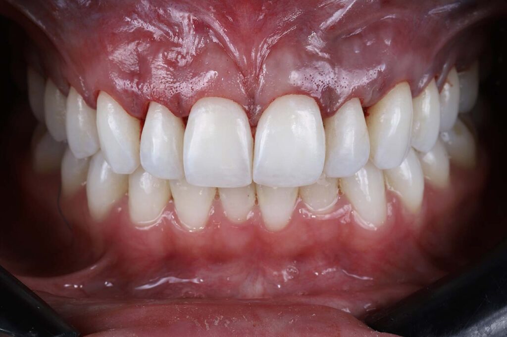 Imagem em close de uma boca fechada, em que é possível ver os dentes superiores e inferiores, assim como a gengiva.
