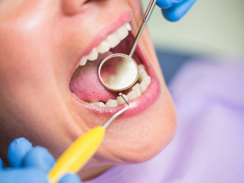 Imagem em close da boca de uma mulher branca. Ela está deitada em uma cadeira odontológica e usa um babador lilás. Mais à esquerda, sua boca está aberta e duas mãos com luvas azuis seguram instrumentos odontológicos próximo aos seus dentes de baixo.