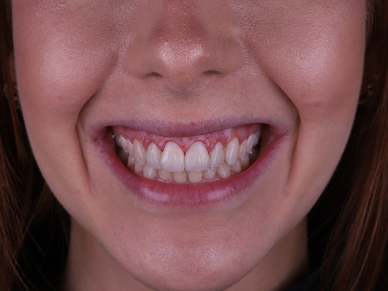Foto em detalhe do sorriso de uma mulher branca. A gengiva da arcada dentária superior esta levemente avermelhada após a colocação do biovolume gengival.