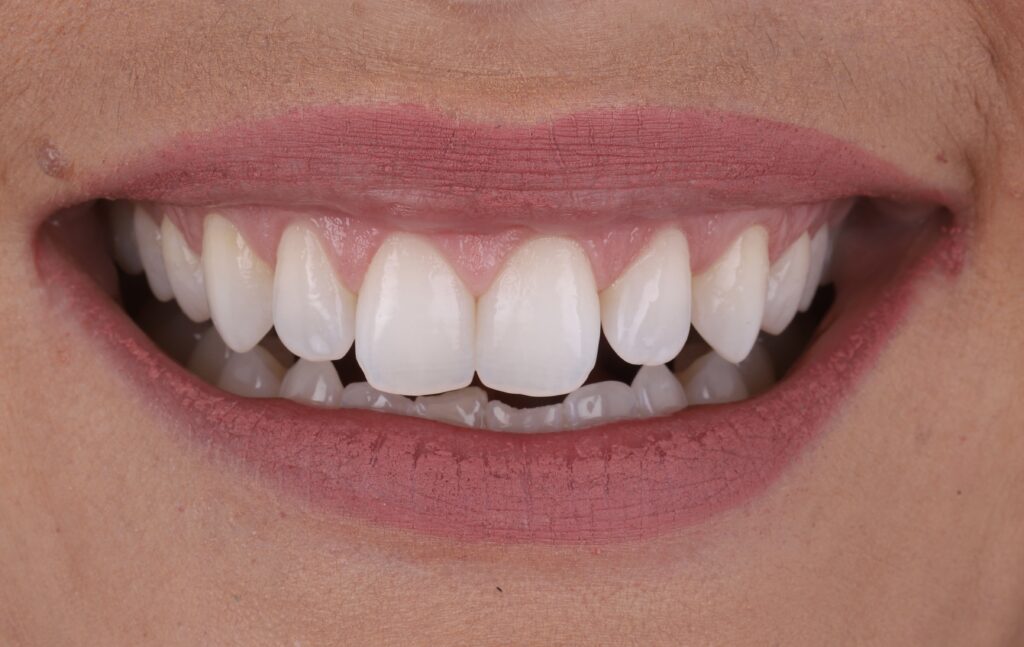 Sorriso pós cirurgia de gengivoplastia