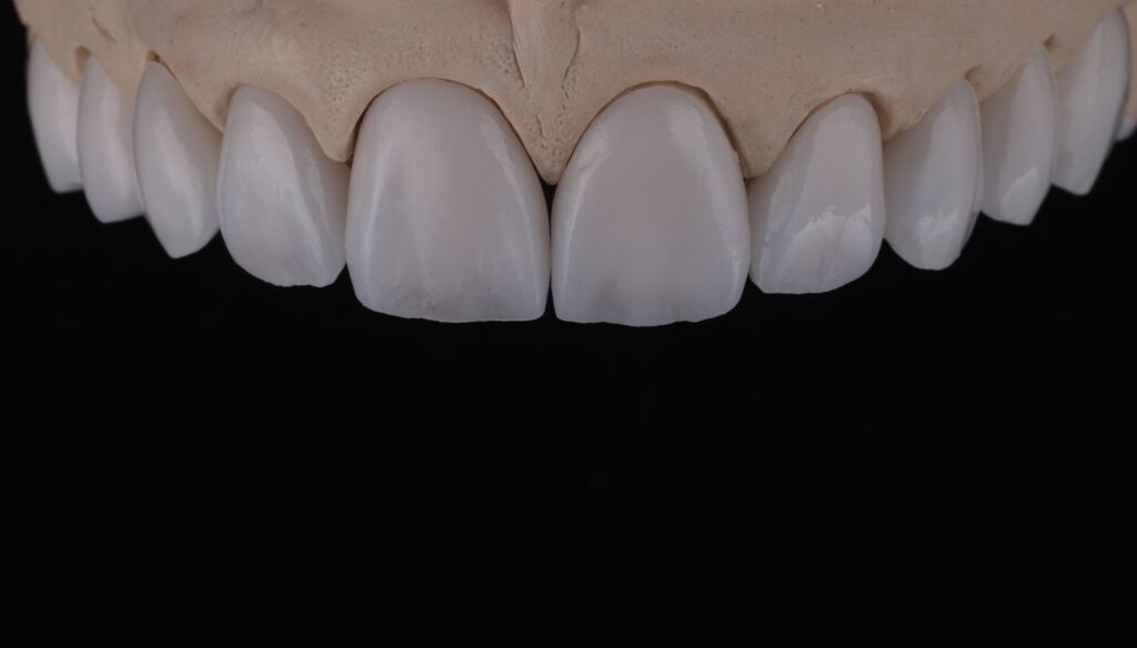 Lentes de contato dental